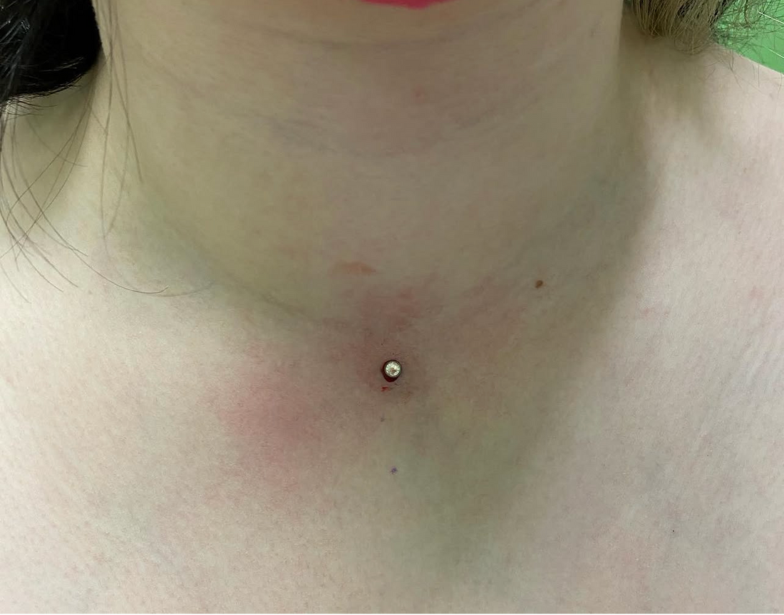 Single-point dermal anchor placed on the throat