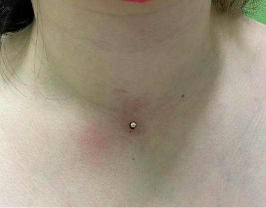 Single-point dermal anchor placed on the throat