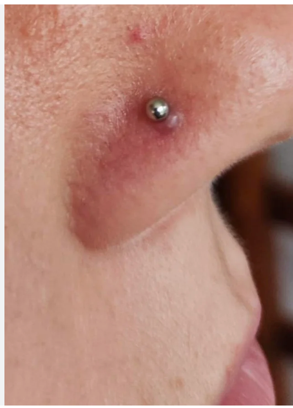 piercing bump on a nose piercing