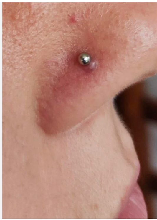 piercing bump on a nose piercing
